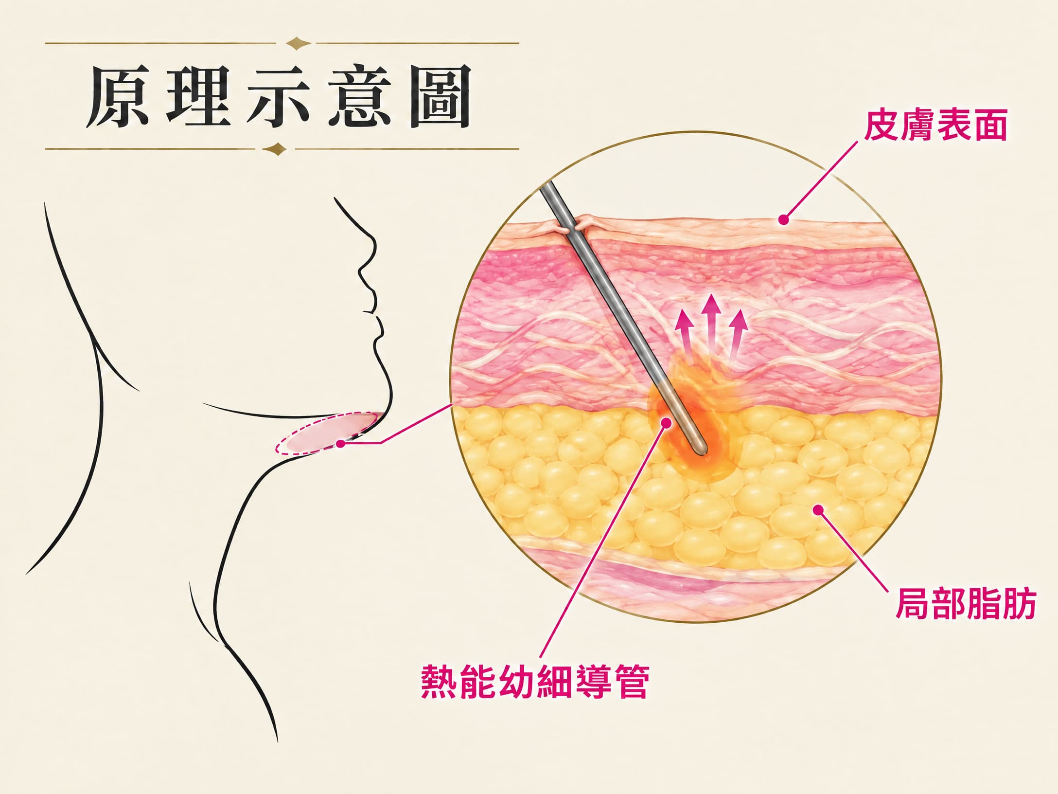 針對局部脂肪,同時兼顧皮膚緊緻。原理示意,非療程實拍。
