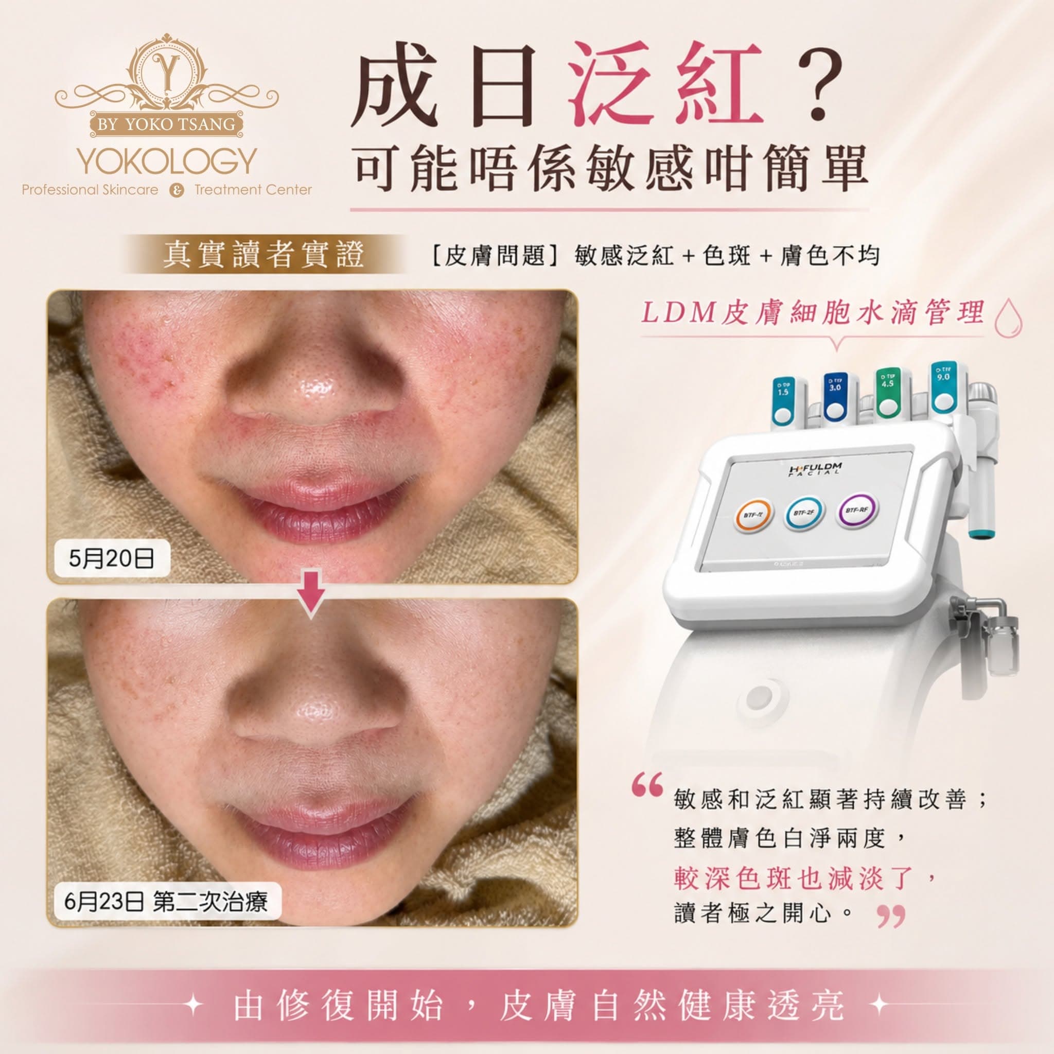 LDM 細胞水滴管理 真實案例 Before After