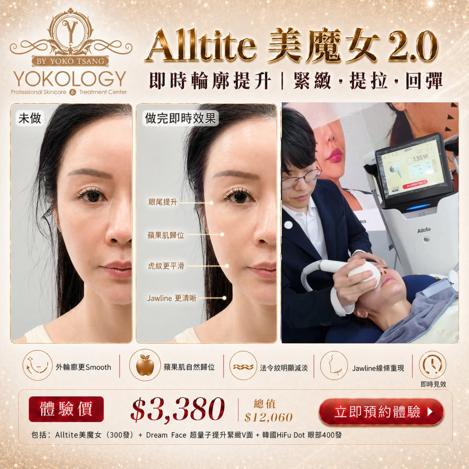 Alltite 美魔女 真實案例 Before After