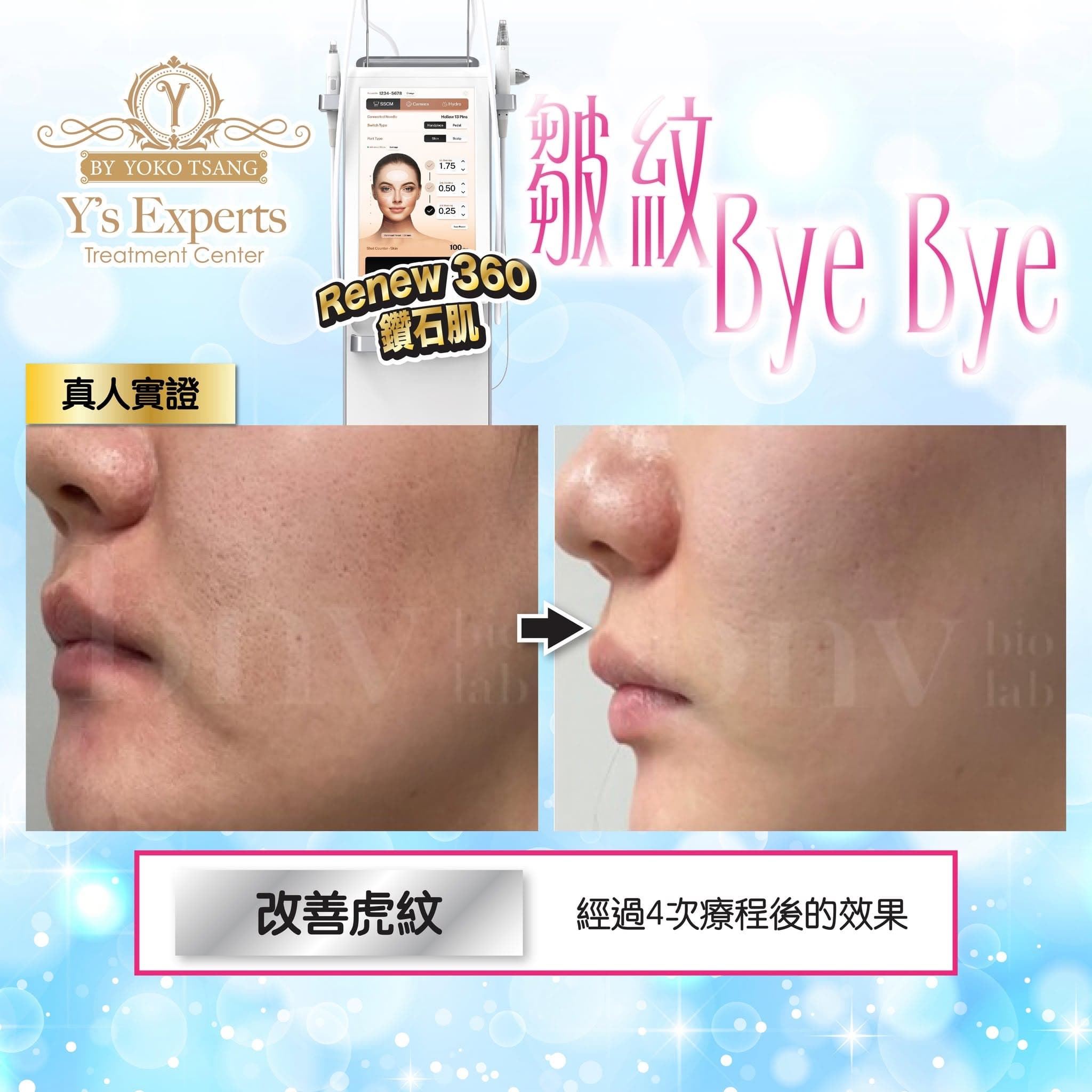 360鑽石肌 真實案例 Before After